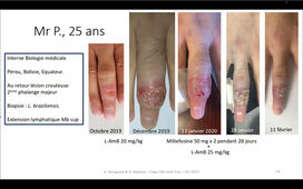 Leishmanioses Dr Arnaud Desclaux  .mp4