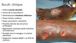 Dermatologie Tropicale et des voyageurs Dr Blaizot.mp4